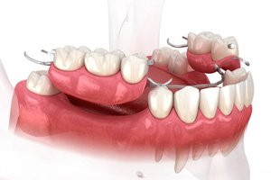 3D digital illustration of partial dentures