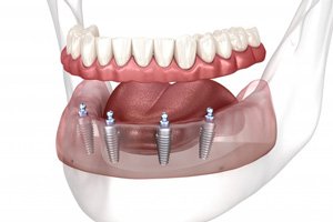 a 3D digital illustration of an implant denture
