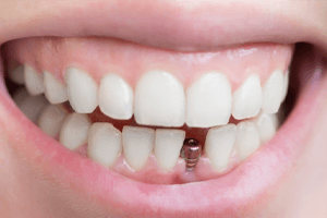 a smiling dental patient looking in a handheld mirror