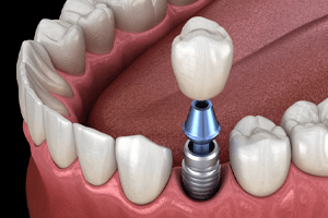 a computer illustration of an implant bridge