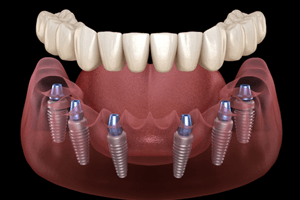 a stack of money with dental tools on top