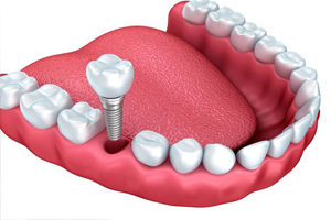 implant supported dental crown