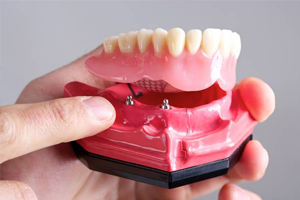 full implant denture model