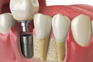 dental implant components