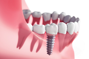 Digital model of a single dental implant.