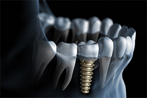 Animation of implant supported dental crown