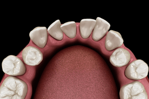 an illustration of overcrowded teeth