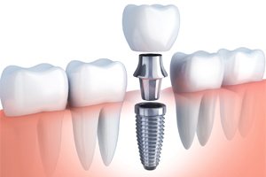 single unit implant