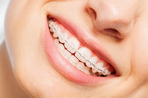 Close-up of woman’s smile with clear braces