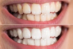 Before and after teeth whitening