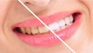 Want a bright smile from a trusted dentist in Oakton? Oakton Dentistry by Design is your choice for superior cosmetic services for a perfect grin. 