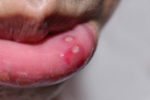 A person’s lip with sores on it.