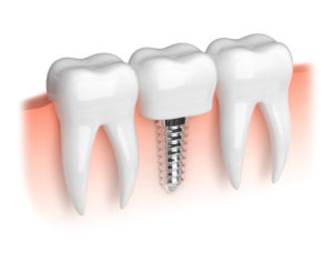 dental implant surrounding teeth white