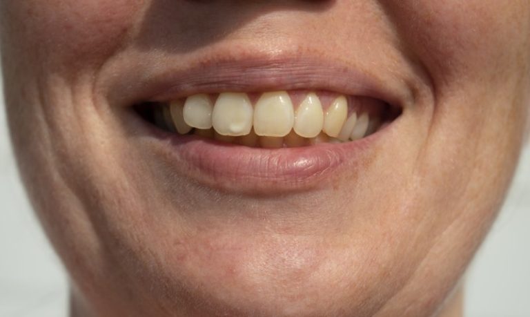 Why do white spots appear on teeth