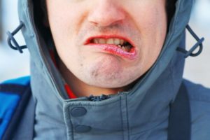 closeup of man with winter mouth issues