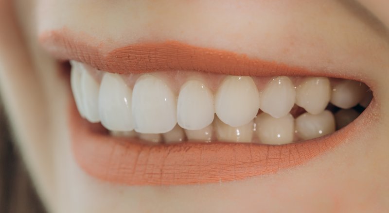 Woman with porcelain veneers