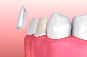 Model showing how much enamel needs to be removed for veneers