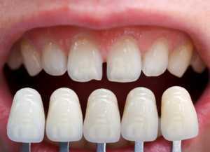 Close up of a set of veneers being compared to a patient’s natural teeth